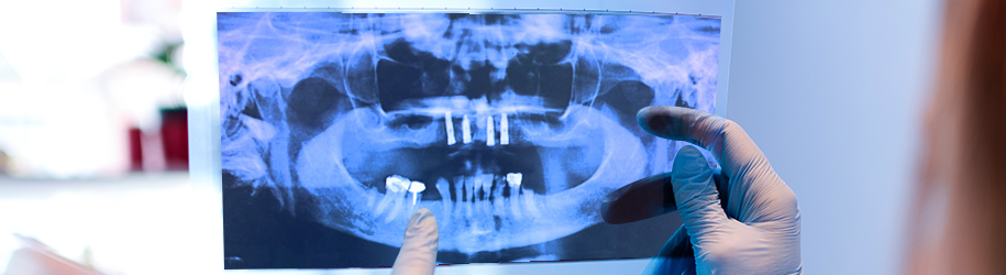 Paciente sin dientes en el maxilar superior